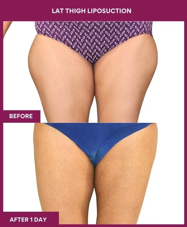 thigh-liposuction-before-after-results-mumbai-india-patient05-front