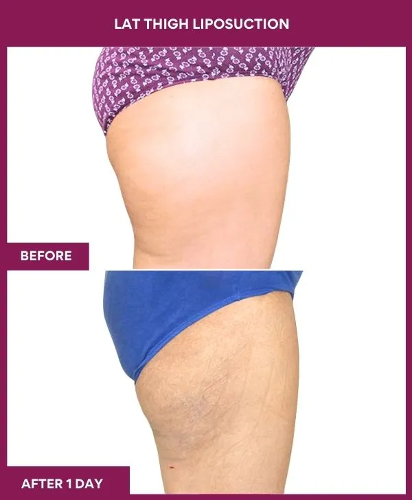 thigh-liposuction-before-after-results-mumbai-india-patient05-side-right