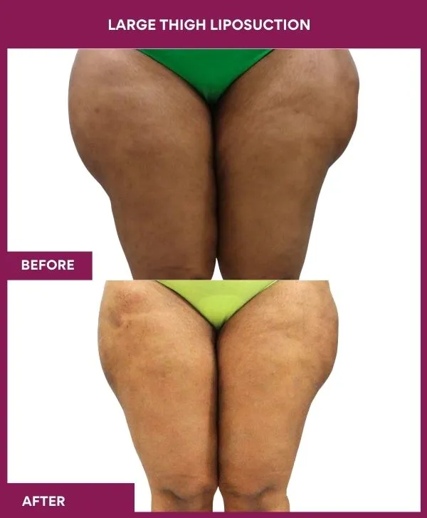 thigh-liposuction-before-after-results-mumbai-india-patient06-front