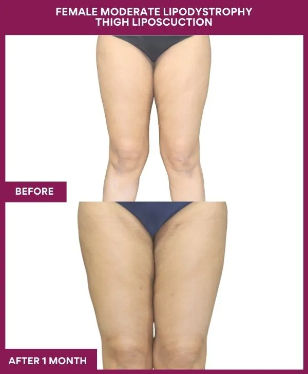 thigh-liposuction-before-after-results-mumbai-india-patient07-front