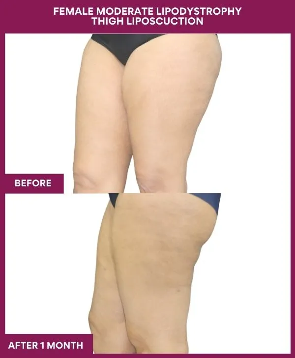 thigh-liposuction-before-after-results-mumbai-india-patient07-side-left
