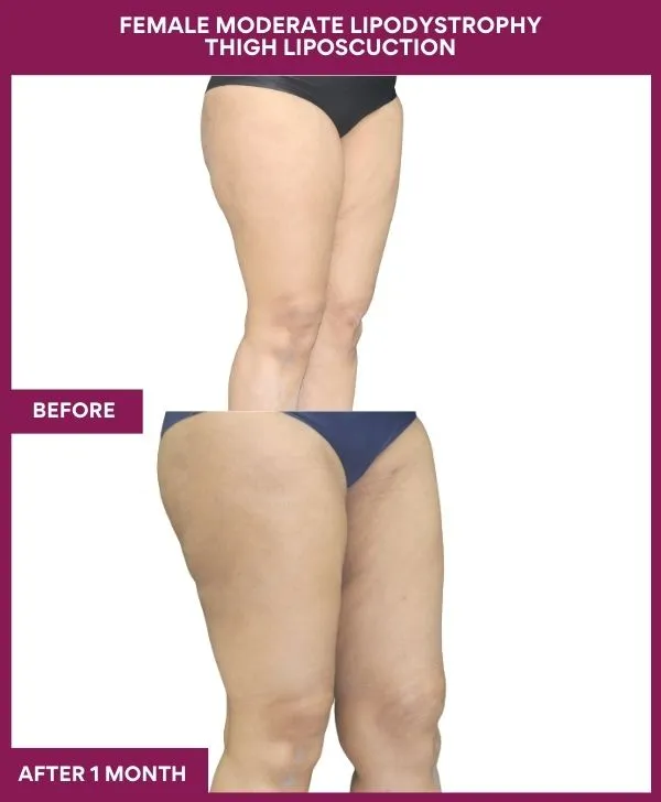 thigh-liposuction-before-after-results-mumbai-india-patient07-side-right