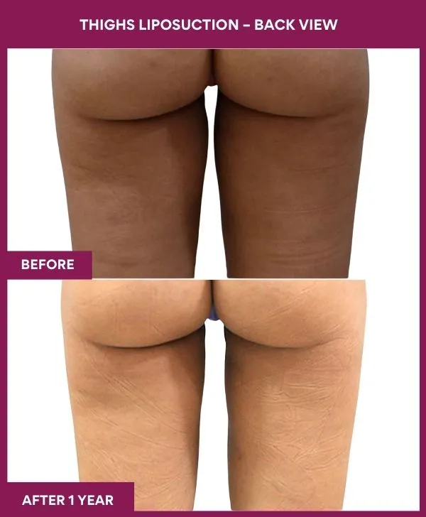 thigh-liposuction-before-after-results-mumbai-india-patient08-back