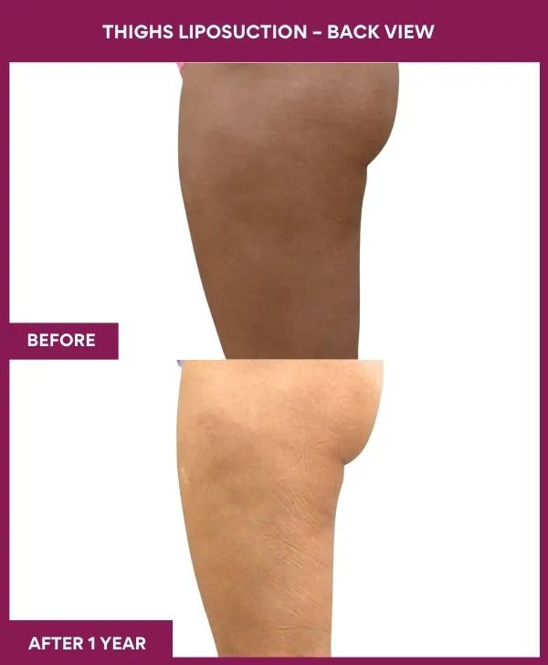 thigh-liposuction-before-after-results-mumbai-india-patient08-side-left