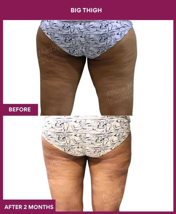 thigh-liposuction-before-after-results-mumbai-india-patient09-back