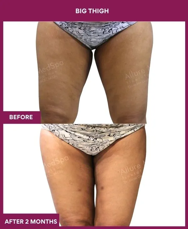 thigh-liposuction-before-after-results-mumbai-india-patient09-front