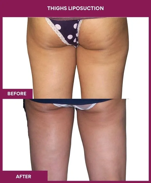 thigh-liposuction-before-after-results-mumbai-india-patient10-front