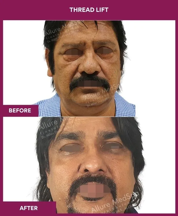 thread-lift-before-after-results-mumbai-india-patient01-front