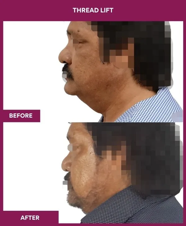thread-lift-before-after-results-mumbai-india-patient01-side-left