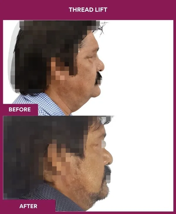 thread-lift-before-after-results-mumbai-india-patient01-side-right
