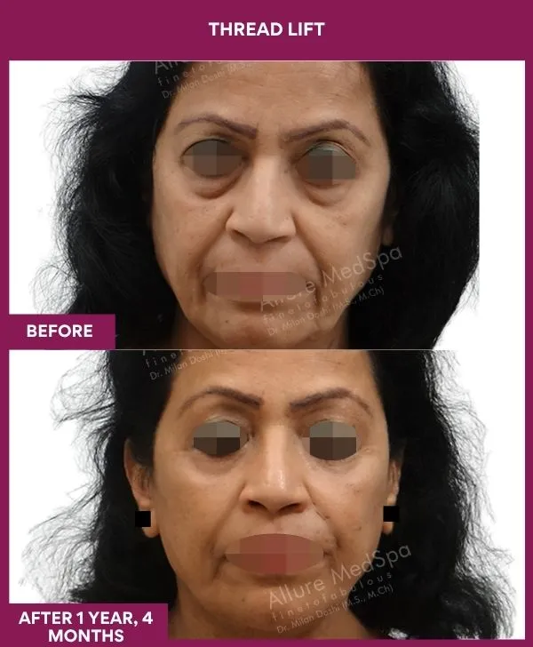 thread-lift-before-after-results-mumbai-india-patient02-front
