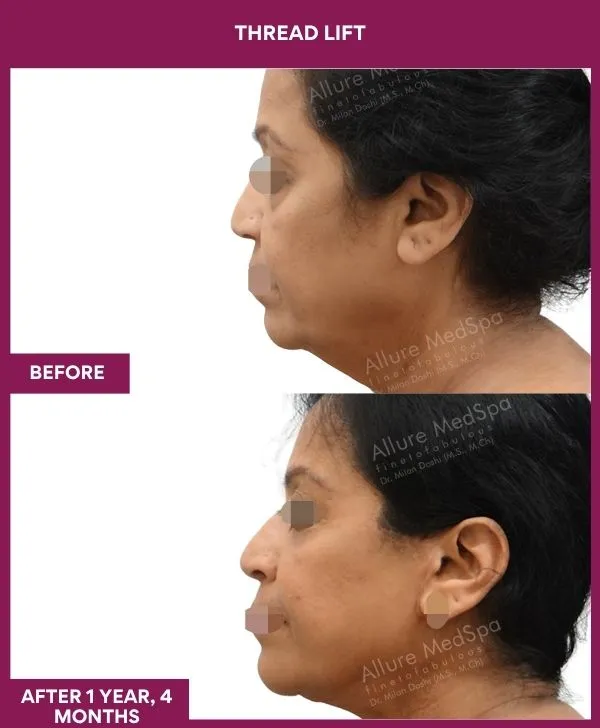 thread-lift-before-after-results-mumbai-india-patient02-side-right