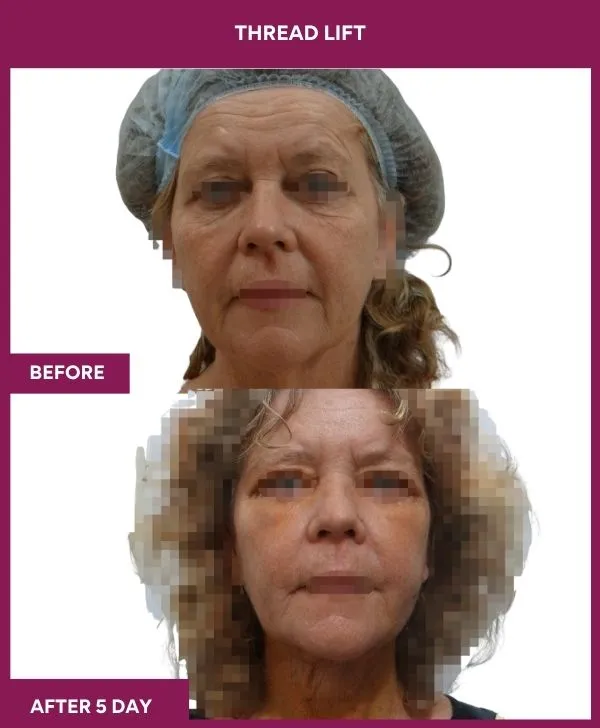 thread-lift-before-after-results-mumbai-india-patient03-front