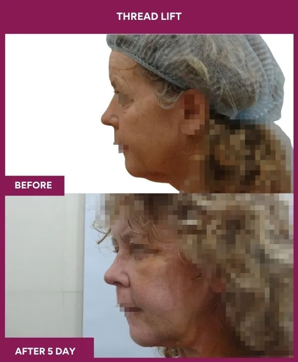 thread-lift-before-after-results-mumbai-india-patient03-side-left