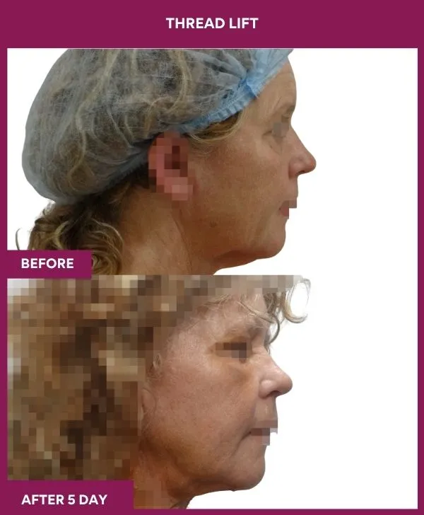 thread-lift-before-after-results-mumbai-india-patient03-side-right