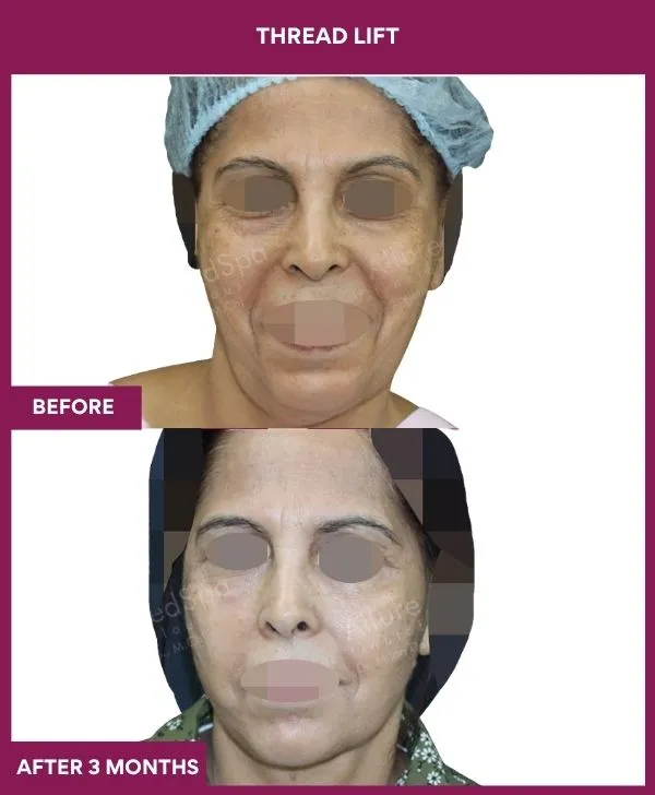 thread-lift-before-after-results-mumbai-india-patient04-front
