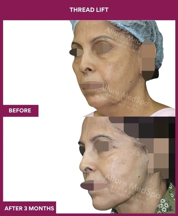 thread-lift-before-after-results-mumbai-india-patient04-side-left