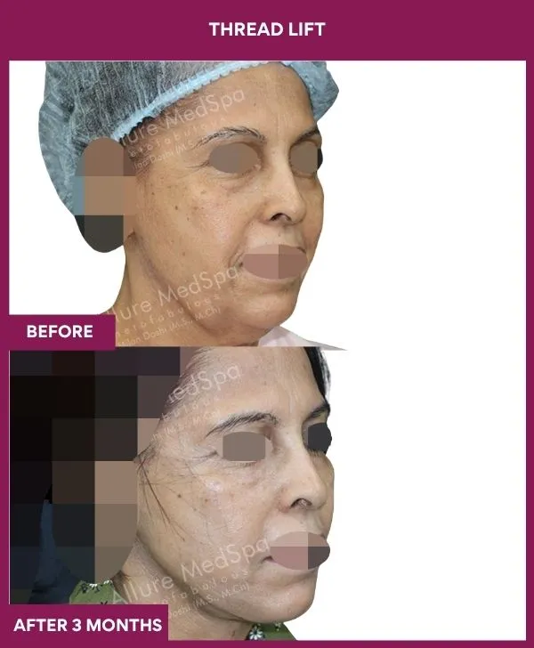 thread-lift-before-after-results-mumbai-india-patient04-side-right