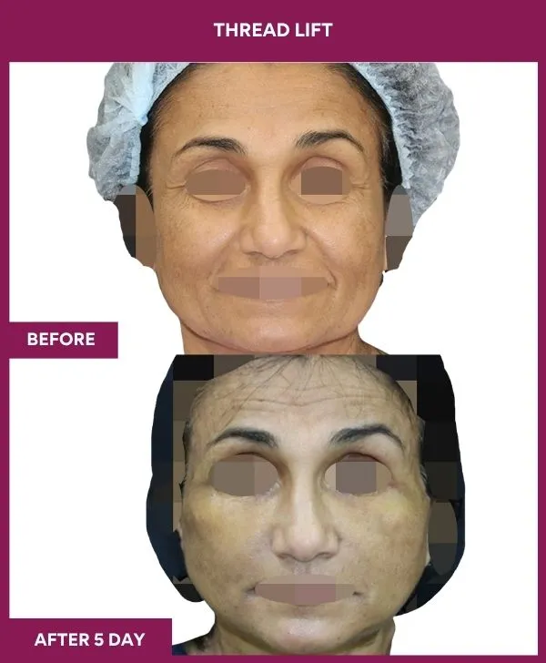 thread-lift-before-after-results-mumbai-india-patient05-front
