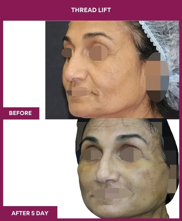 thread-lift-before-after-results-mumbai-india-patient05-side-left