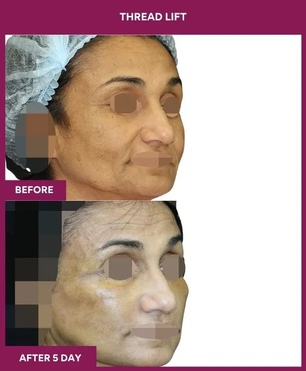 thread-lift-before-after-results-mumbai-india-patient05-side-right
