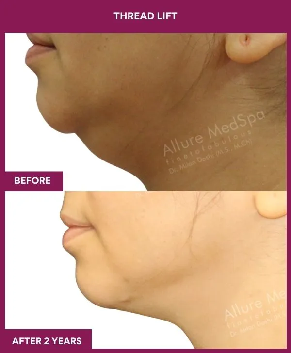 thread-lift-before-after-results-mumbai-india-patient06-side-left