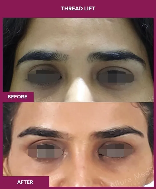 thread-lift-before-after-results-mumbai-indiapatient07-front