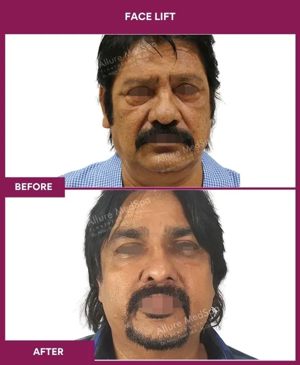 facelift-surgery-before-after-results-mumbai-patient01-front