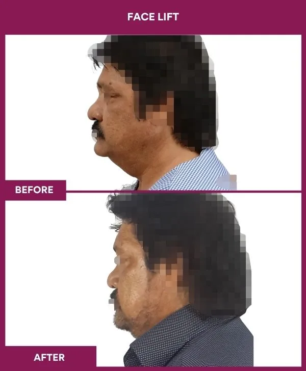 facelift-surgery-before-after-results-mumbai-patient01-side-left