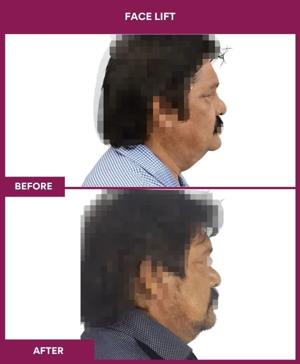 facelift-surgery-before-after-results-mumbai-patient01-side-right