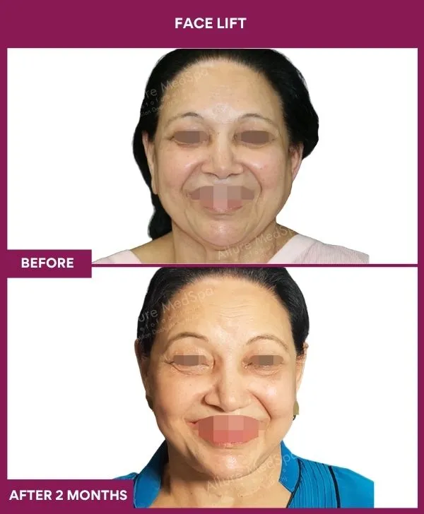 facelift-surgery-before-after-results-mumbai-patient02-front