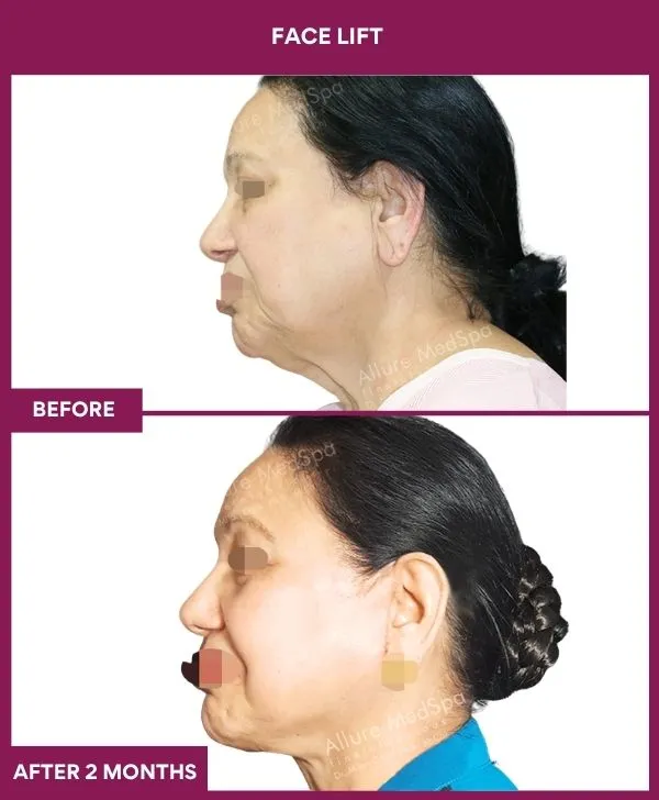 facelift-surgery-before-after-results-mumbai-patient02-side-left