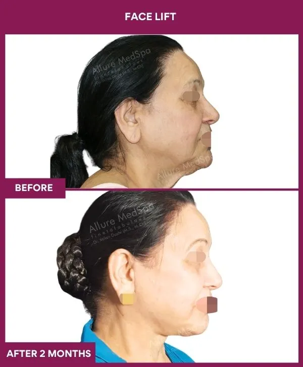 facelift-surgery-before-after-results-mumbai-patient02-side-right