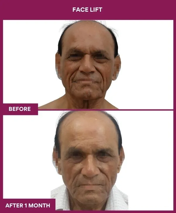 facelift-surgery-before-after-results-mumbai-patient03-front