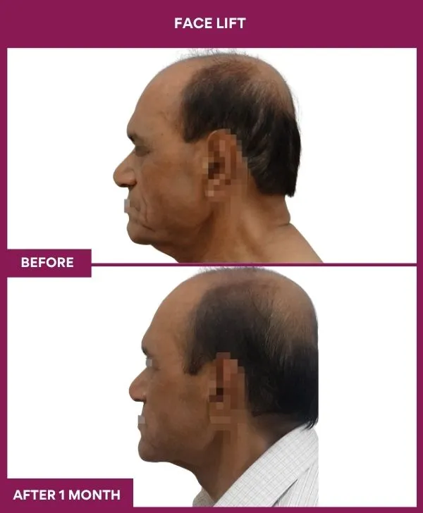 facelift-surgery-before-after-results-mumbai-patient03-side-left