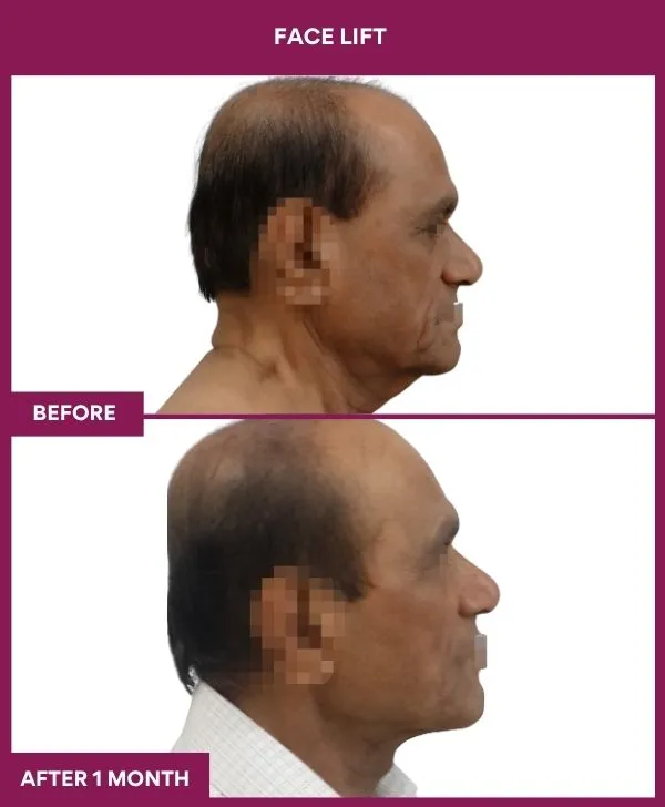 facelift-surgery-before-after-results-mumbai-patient03-side-right
