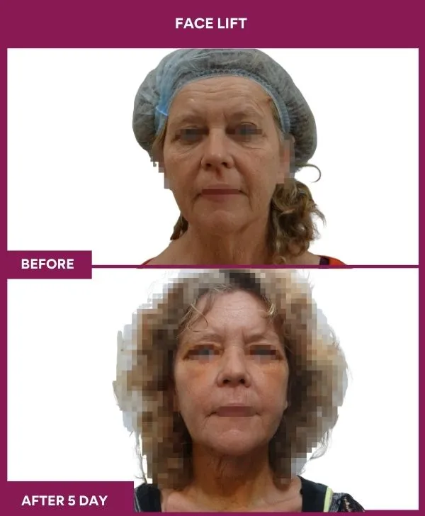 facelift-surgery-before-after-results-mumbai-patient04-front