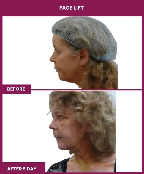 facelift-surgery-before-after-results-mumbai-patient04-side-left