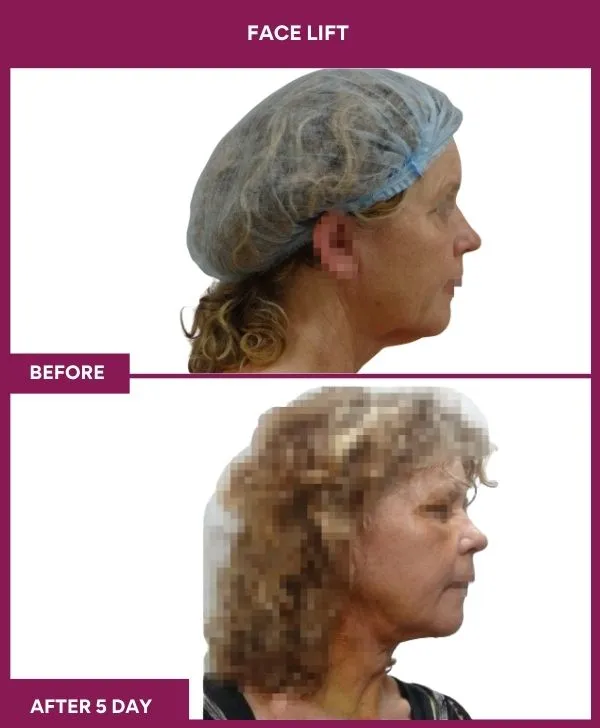 facelift-surgery-before-after-results-mumbai-patient04-side-right