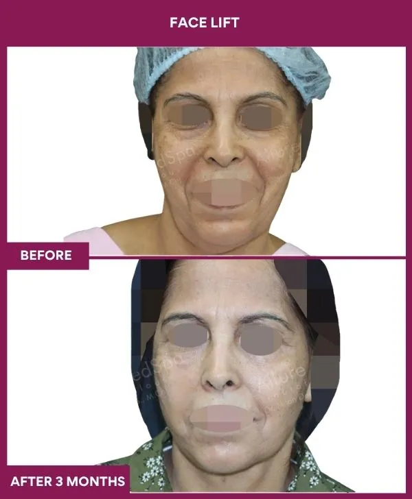 facelift-surgery-before-after-results-mumbai-patient05-front