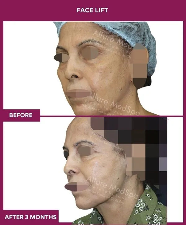 facelift-surgery-before-after-results-mumbai-patient05-side-left