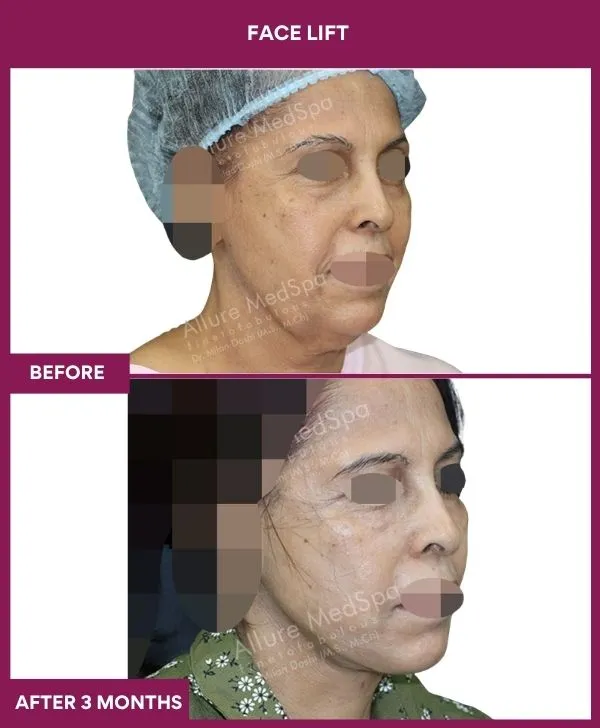 facelift-surgery-before-after-results-mumbai-patient05-side-right