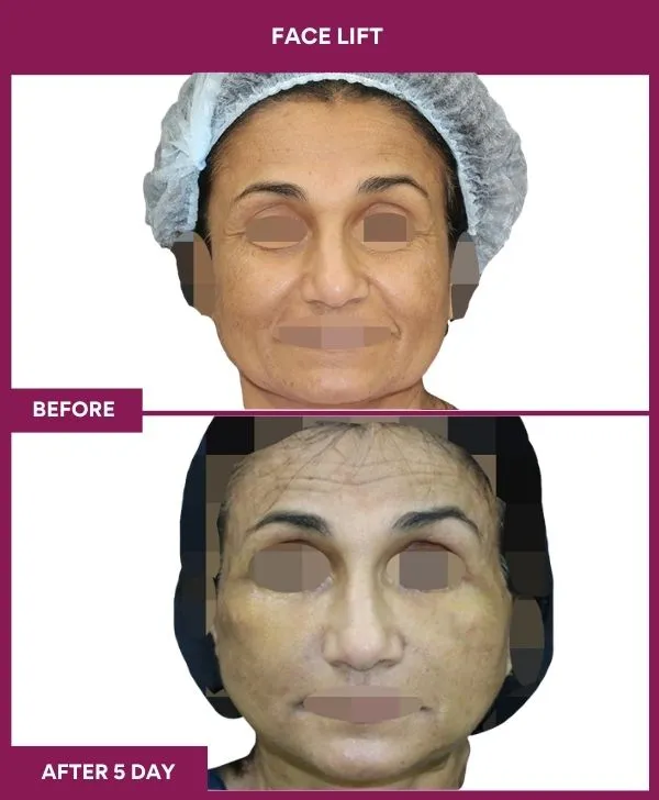 facelift-surgery-before-after-results-mumbai-patient06-front