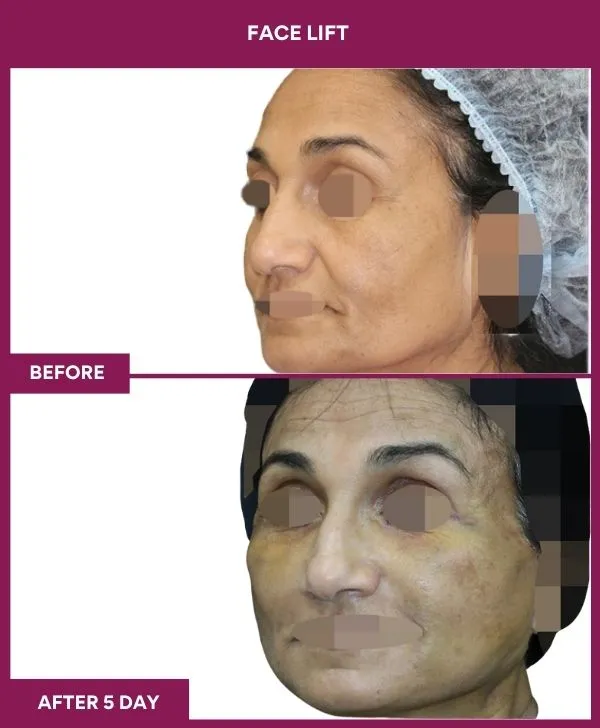 facelift-surgery-before-after-results-mumbai-patient06-side-left