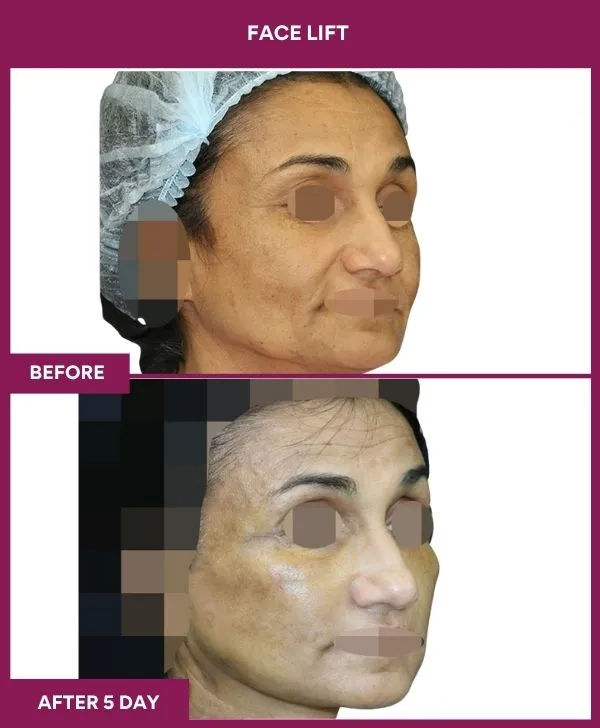 facelift-surgery-before-after-results-mumbai-patient06-side-right