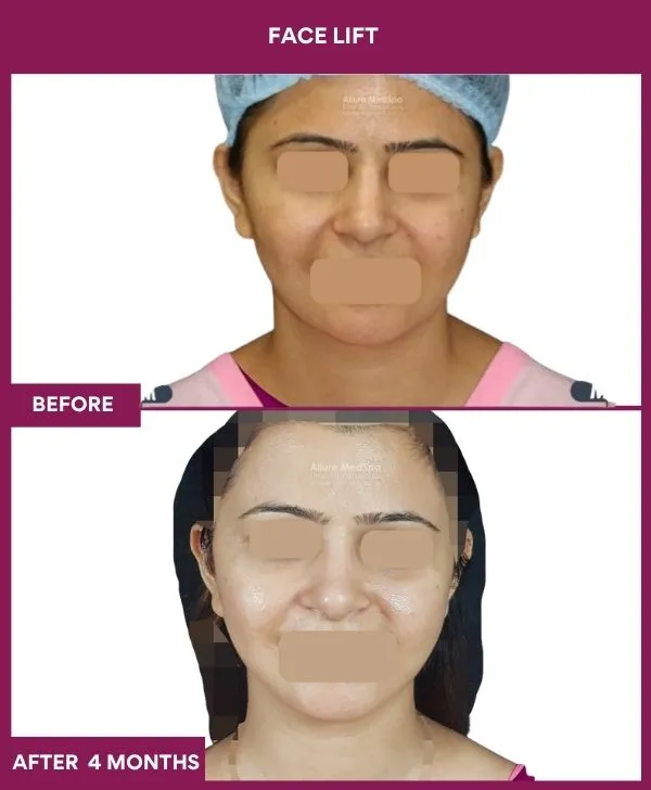 facelift-surgery-before-after-results-mumbai-patient07-front