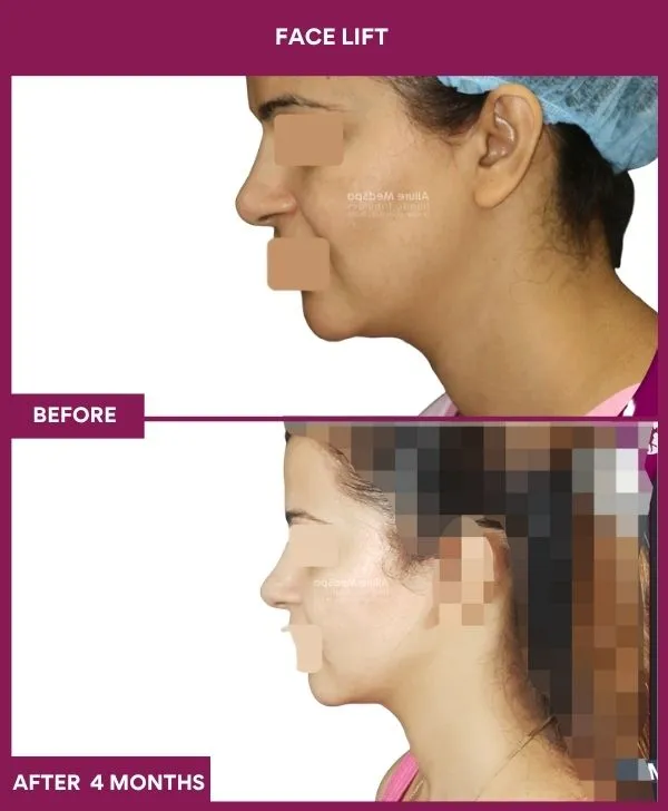 facelift-surgery-before-after-results-mumbai-patient07-side-left