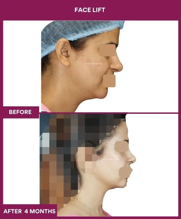 facelift-surgery-before-after-results-mumbai-patient07-side-right