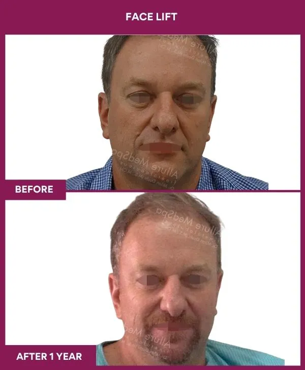 facelift-surgery-before-after-results-mumbai-patient08-front