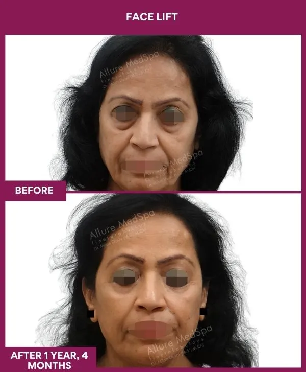 facelift-surgery-before-after-results-mumbai-patient09-front